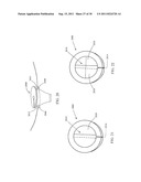 DEVICES, SYSTEMS, AND METHODS FOR CLOSING A HOLE IN CARDIAC TISSUE diagram and image