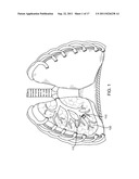 IMPLANTED BRONCHIAL ISOLATION DEVICES AND METHODS diagram and image