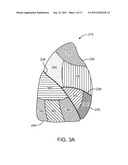 IMPLANTED BRONCHIAL ISOLATION DEVICES AND METHODS diagram and image