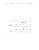 GENETIC ALTERATIONS IN ISOCITRATE DEHYDROGENASE AND OTHER GENES IN     MALIGNANT GLIOMA diagram and image