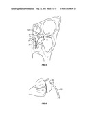 Arterial Tamponade Device and Method diagram and image