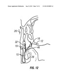 Arterial Tamponade Device and Method diagram and image