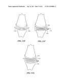 Patient Selectable Joint Arthroplasty Devices and Surgical Tools diagram and image