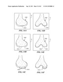 Patient Selectable Joint Arthroplasty Devices and Surgical Tools diagram and image