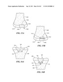 Patient Selectable Joint Arthroplasty Devices and Surgical Tools diagram and image