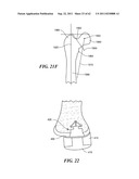 Patient Selectable Joint Arthroplasty Devices and Surgical Tools diagram and image