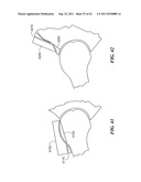 Patient Selectable Joint Arthroplasty Devices and Surgical Tools diagram and image