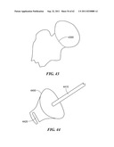 Patient Selectable Joint Arthroplasty Devices and Surgical Tools diagram and image