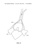 Patient Selectable Joint Arthroplasty Devices and Surgical Tools diagram and image