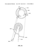 Patient Selectable Joint Arthroplasty Devices and Surgical Tools diagram and image