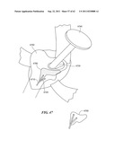 Patient Selectable Joint Arthroplasty Devices and Surgical Tools diagram and image