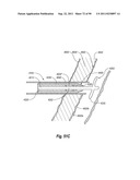 CLIP APPLIER AND METHODS OF USE diagram and image