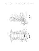 ANTERIOR BRACKET FOR SPINAL FIXATION diagram and image