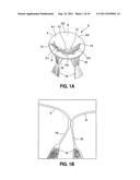 DYNAMICALLY ADJUSTABLE SUTURE AND CHORDAE TENDINAE diagram and image