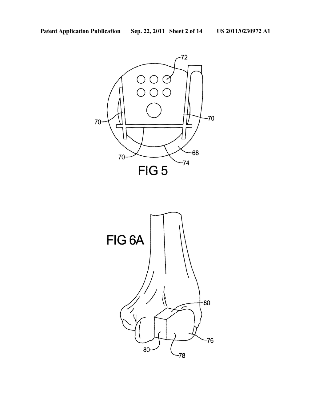 ELBOW RESURFACING PROSTHESIS - diagram, schematic, and image 03