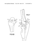 ELBOW RESURFACING PROSTHESIS diagram and image