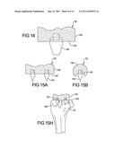 ELBOW RESURFACING PROSTHESIS diagram and image