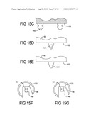 ELBOW RESURFACING PROSTHESIS diagram and image