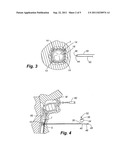 AIRWAY ANCHOR SUTURE TO PREVENT AIRWAY STENT MIGRATION diagram and image