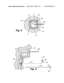 AIRWAY ANCHOR SUTURE TO PREVENT AIRWAY STENT MIGRATION diagram and image