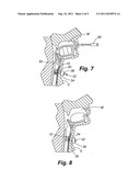 AIRWAY ANCHOR SUTURE TO PREVENT AIRWAY STENT MIGRATION diagram and image