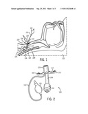 TRACHEOSTOMY TUBE WITH FILLETED FLANGE diagram and image