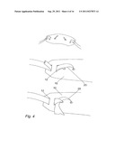 PELVIC IMPLANT WITH SELECTIVE LOCKING ANCHOR diagram and image