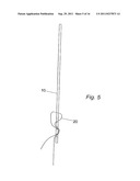 PELVIC IMPLANT WITH SELECTIVE LOCKING ANCHOR diagram and image