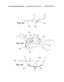 PELVIC IMPLANT WITH SELECTIVE LOCKING ANCHOR diagram and image