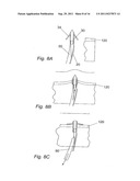 PELVIC IMPLANT WITH SELECTIVE LOCKING ANCHOR diagram and image