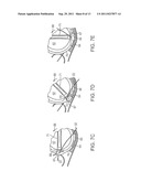 PELVIC IMPLANT WITH SUSPENDING SYSTEM diagram and image