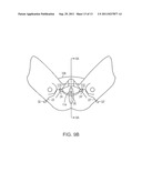 PELVIC IMPLANT WITH SUSPENDING SYSTEM diagram and image