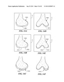 Patient Selectable Joint Arthroplasty Devices and Surgical Tools diagram and image