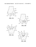 Patient Selectable Joint Arthroplasty Devices and Surgical Tools diagram and image