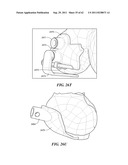 Patient Selectable Joint Arthroplasty Devices and Surgical Tools diagram and image