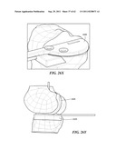 Patient Selectable Joint Arthroplasty Devices and Surgical Tools diagram and image