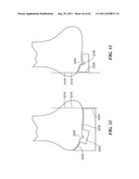 Patient Selectable Joint Arthroplasty Devices and Surgical Tools diagram and image