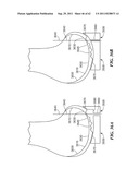 Patient Selectable Joint Arthroplasty Devices and Surgical Tools diagram and image