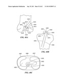 Patient Selectable Joint Arthroplasty Devices and Surgical Tools diagram and image