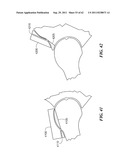 Patient Selectable Joint Arthroplasty Devices and Surgical Tools diagram and image