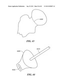 Patient Selectable Joint Arthroplasty Devices and Surgical Tools diagram and image