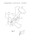 Patient Selectable Joint Arthroplasty Devices and Surgical Tools diagram and image