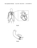 MEDICAL DEVICE FOR TREATING A HEART VALVE INSUFFICIENCY diagram and image