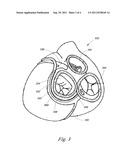 ANNULOPLASTY DEVICE diagram and image