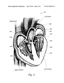 ANNULOPLASTY DEVICE diagram and image