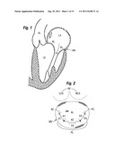 MITRAL ANNULOPLASTY RINGS WITH SEWING CUFF diagram and image