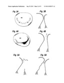 MITRAL ANNULOPLASTY RINGS WITH SEWING CUFF diagram and image