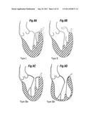 MITRAL ANNULOPLASTY RINGS WITH SEWING CUFF diagram and image