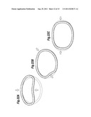 MITRAL ANNULOPLASTY RINGS WITH SEWING CUFF diagram and image