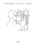 ORTHOVOLTAGE RADIOTHERAPY diagram and image